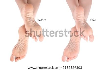 Feet with dry skin before and after treatment. foot cream, moisturizer. Dry and cracked soles of feet. female legs in an elegant position. sore skin of feet, dry heels Royalty-Free Stock Photo #2152529303