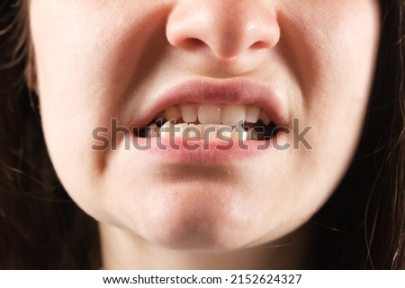 Patient with dislocated jaw and malocclusion, temporomandibular joint dysfunction, close-up. Royalty-Free Stock Photo #2152624327