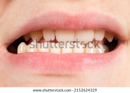 Patient with dislocated jaw and malocclusion, temporomandibular joint dysfunction, close-up. Royalty-Free Stock Photo #2152624329