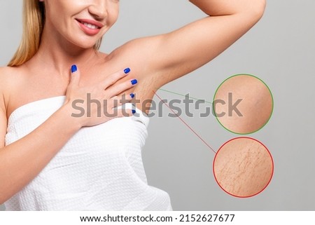 Young beautiful smiling woman showing the smooth skin of her armpits. Enlarged area with results before and after depilation procedures. The concept of photoepilation and laser hair removal Royalty-Free Stock Photo #2152627677