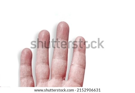 Young male hand with dry skin and dry fingers, peel, Contact dermatitis, fungal infections, Eczema  medical condition called dyshidrotic pompholyx or vesicular dyshidrosis. Healthcare, Medical concept