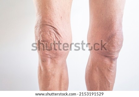Leg and knee of an old man with synovial problems on a white background	 Royalty-Free Stock Photo #2153191529