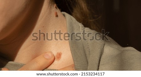 Birthmarks on skin Close up detail of the bare skin Sun Exposure effect on skin, Health Effects of UV Radiation Woman with birthmarks Pigmentation and lot of birthmarks. Royalty-Free Stock Photo #2153234117