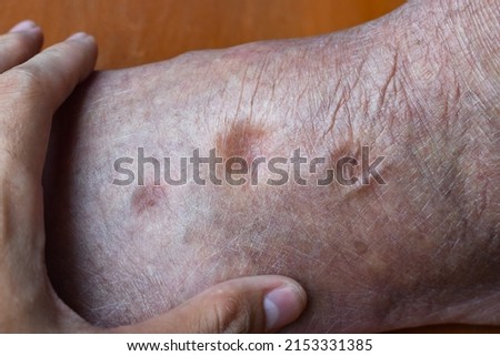 Pitting edema of lower limb. Swollen leg of Asian old man. Royalty-Free Stock Photo #2153331385