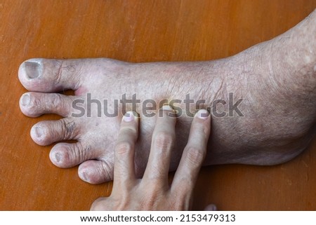 Pitting edema of lower limb. Swollen foot of Asian old man. Royalty-Free Stock Photo #2153479313