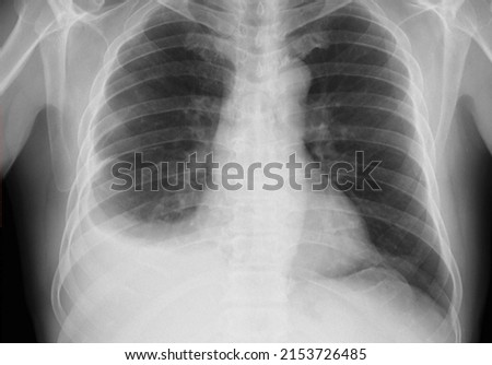 Pleural effusion in chest x-ray, A pleural effusion is a collection of fluid in the pleural space, its shown as  uniformly white lesion on chest x ray, Royalty-Free Stock Photo #2153726485