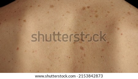 Close-up of large rashes or smallpox on the skin of an adult male. Pigmented spots on the back of a man. Skin of a man with moles. Acne. Royalty-Free Stock Photo #2153842873