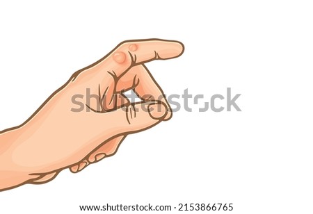 Vector illustration of blister on finger,heat blister with fluid inside,index finger was burning swelling hurt pain,accidents,injuries,on white,Health care Be careful,Prevent accidents from negligence Royalty-Free Stock Photo #2153866765