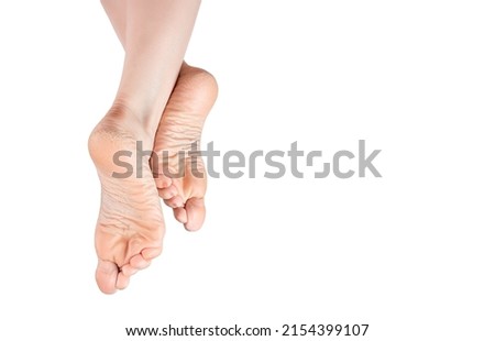 rough skin on soles of feet. dry heels, dry chapped skin on feet requiring care isolated on white background, dry skin on heels and soles needs care. copy space Royalty-Free Stock Photo #2154399107
