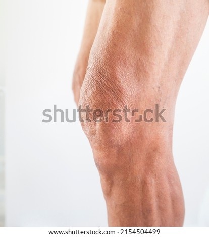 Leg and knee of an old man with synovial problems on a white background Royalty-Free Stock Photo #2154504499