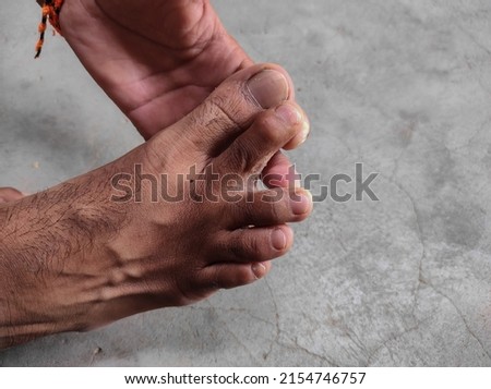 A Closeup Shot Of Skin Peeling On Feet Fingers 