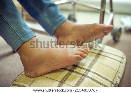 Elderly foot care. Old Asian Indian woman with bare feet, oedema with swollen feet and ankles, UK Royalty-Free Stock Photo #2154850767