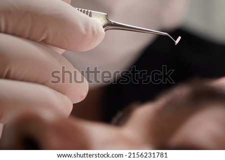 hair transplant. fue technique. dhi technique. hair loss Royalty-Free Stock Photo #2156231781