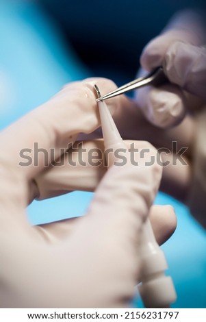 hair transplant. fue technique. dhi technique. hair loss Royalty-Free Stock Photo #2156231797
