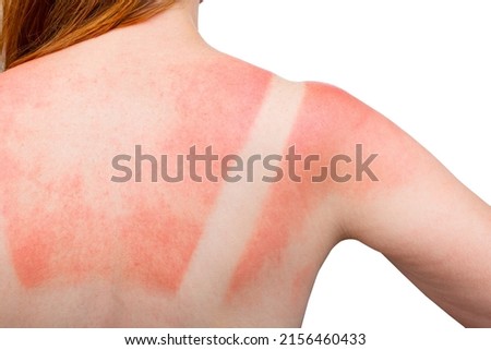 Sunburn. Woman got a Sunburn. Red painful skin on back that feels hot to the touch after beach visits. Use Sunscreen or UV protection cream. Summer vacation on ocean beach. White Isolated background. Royalty-Free Stock Photo #2156460433