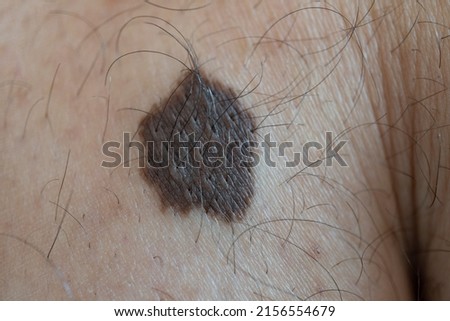 Big skin mole on the leg of a young guy. Macro picture.