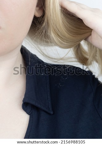 Dandruff on a blond woman shoulder. Side view of a female who has more dandruff flakes on his black shirt. Scalp disease treatment concept. Discomfort from a fungal infection. Head fungus