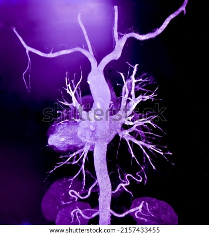 CT Angiography (Computed tomography angiography: CTA) of abdominal aorta, Rupture of an abdominal aortic aneurysm

 Royalty-Free Stock Photo #2157433455