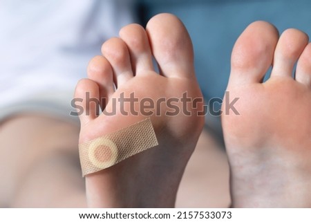Woman's foot with glued medical plaster for plantar wart. Treatment of calluses and warts on the feet, dermatological Royalty-Free Stock Photo #2157533073