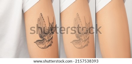 Woman before and after laser tattoo removal procedures, closeup. Collage with photos, banner design Royalty-Free Stock Photo #2157538393