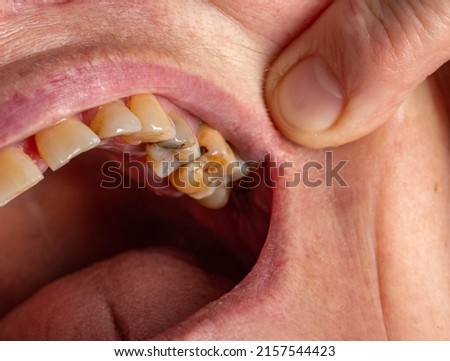 Teeth with caries and pulpous teeth in the mouth of a female patient. Dental treatment in dentistry Royalty-Free Stock Photo #2157544423