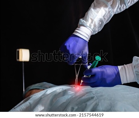 surgery to remove the pancreas and take a biopsy of the patient's liver, close-up. Laparoscopic Royalty-Free Stock Photo #2157544619