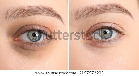 Collage with photos of tired woman with dark circle under eye and after rest, closeup. Banner design