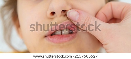 The child has stomatitis on the lip. Selective focus. Kid. Royalty-Free Stock Photo #2157585527