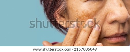 Menopausal women worry about melasma on face. Royalty-Free Stock Photo #2157805049