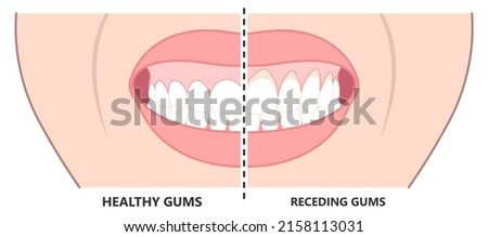 Gingivectomy gum graft smile small teeth deep cleaning prep flap dental attached gingiva alveolar bone laser tooth Care lift tissue treat clean plaque bacteria Tartar calculus Royalty-Free Stock Photo #2158113031