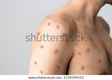 Monkeypox new disease dangerous over the world. Royalty-Free Stock Photo #2158549553