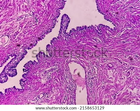 Microscopic image or photomicrograph of Fallopian tube biopsy. Royalty-Free Stock Photo #2158653129