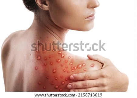 Woman and her skin affected by blistering rash because of monkeypox on white background Royalty-Free Stock Photo #2158713019