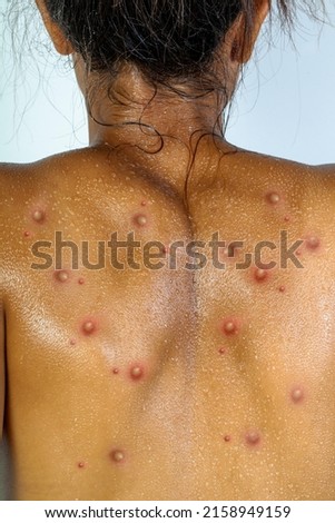 Monkeypox new disease dangerous over the world. Royalty-Free Stock Photo #2158949159