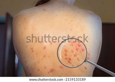 monkeypox infection virus on a woman's skin. Pandemic Monkeypox is a rare disease caused by a virus. Infection in Africa, Europe. Royalty-Free Stock Photo #2159133189