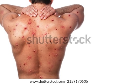 Male back affected by blistering rash because of monkeypox or other viral infection on white background Royalty-Free Stock Photo #2159170535