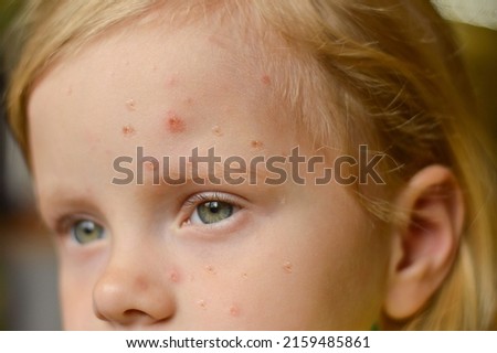 Monkeypox new disease dangerous over the world. Selective focus. Close-up of a Caucasian girl with pimples and ulcers on her face. Royalty-Free Stock Photo #2159485861