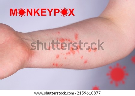 Hand of a young guy in a rash. Monkeypox virus symptoms. Royalty-Free Stock Photo #2159610877