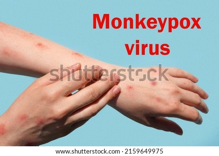 Monkeypox new disease dangerous over the world. Patient with Monkey Pox. Painful rash, red spots blisters on the hand. Close up rash, human hands with Health problem. The word Monkeypox virus. Royalty-Free Stock Photo #2159649975