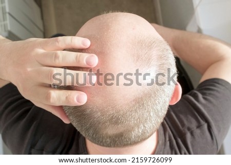 Baldness, man concerned about hair loss. Male head with bald. Male pattern baldness. Fighting hair loss in men Royalty-Free Stock Photo #2159726099