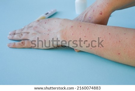 Monkey pox virus, a new world problem of modern humanity. Close-up of the hands of a sick person with pimples and blisters. Smallpox vaccine. Royalty-Free Stock Photo #2160074883