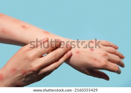 Monkeypox new disease dangerous over the world. Patient with Monkey Pox. Painful rash, red spots blisters on the hand. Close up rash, human hands with Health problem. mpox Royalty-Free Stock Photo #2160355429