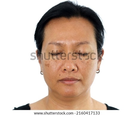 Close up Asian woman face with Problem skincare and health concept. Closeup Asian woman face skin with melasma, Dark spots, pigment and large pores problem. Woman head isolated on white background. Royalty-Free Stock Photo #2160417133