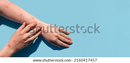 Monkeypox new disease dangerous over the world. Patient with Monkey Pox. Painful rash, red spots blisters on the hand. Close up rash, human hands with Health problem. Banner, copy space Royalty-Free Stock Photo #2160417457