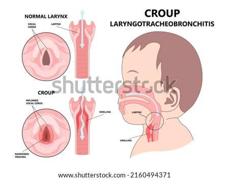 Croup upper airway obstruct virus voice box vocal cord tube swollen noise baby child cold flu sick stuffy runny nose fever common kids lung covid 19 RSV tract high pitched Royalty-Free Stock Photo #2160494371