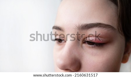 Hordeolum. A teenage girl's eye is painful, red and swollen from stye, a common bacterial eye infection. Close-up. Royalty-Free Stock Photo #2160631517