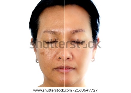 Retouched image to show before and after treatment spot melasma pigmentation facial treatment on young asian woman face. Skincare and health problem concept.