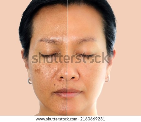 Retouched image before and after spot melasma pigmentation facial treatment on middle age asian woman face. Skincare and health problem concept.  Royalty-Free Stock Photo #2160669231