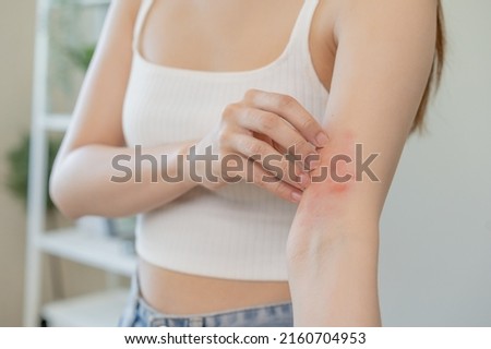 Dermatology asian young woman, girl allergy, allergic reaction from atopic, insect bites on her arm, hand in scratching itchy, itch red spot or rash of skin. Healthcare, treatment of beauty. Royalty-Free Stock Photo #2160704953