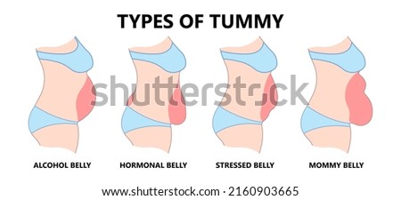 Diastasis Recti six pack separation belly rectus Linea alba abdominal surgical Tummy Tuck skin fat loss c section Ovary Over consuming Bloated Stressed Out childbirth Royalty-Free Stock Photo #2160903665